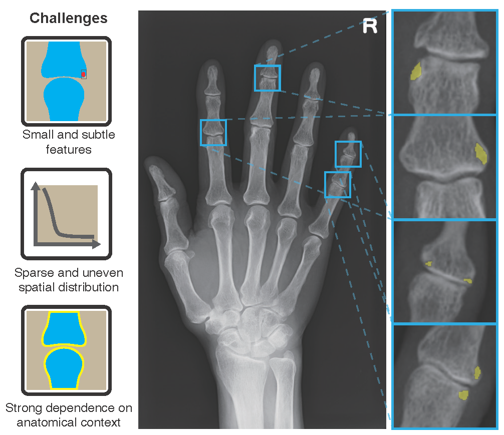 Challenges in bone erosion segmentation